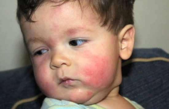 宝宝吃网纹瓜过敏,警惕常见水果的潜在风险